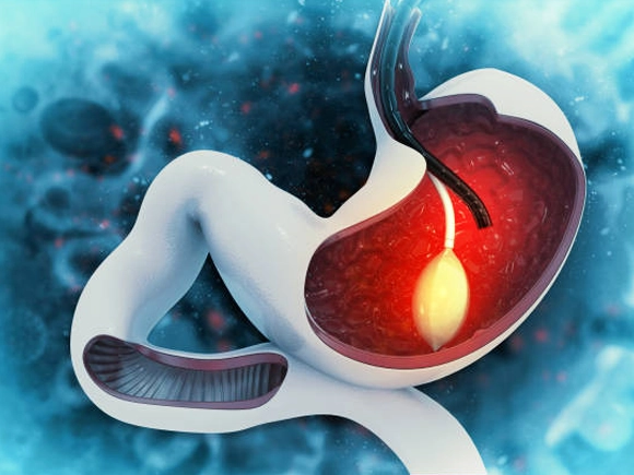 Arma Reflü Tedavisi