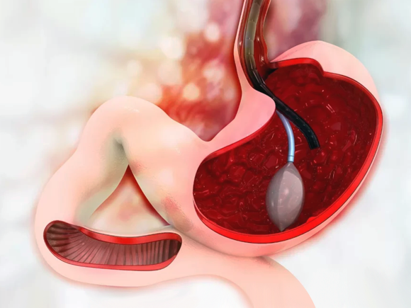 Gastric Balloon Ankara, Turkey