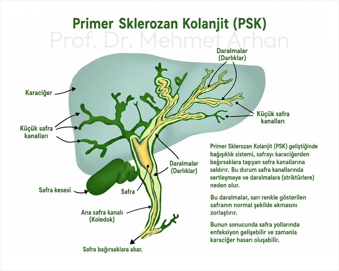 Primer Sklerozan Kolanjit (PSK) Hastalığı